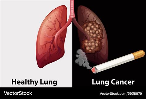 Free access to medicines against lung cancer now available .